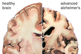 Ալցհեյմերի հիվանդություն
