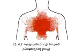 Կրծքահեղձուկի (ստենոկարդիա) նոպա և սրտամկանի ինֆարկտ