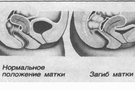 Արգանդի թեքումն ու դրա հետևանքները