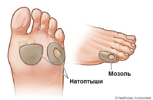 Как избавиться от мозолей легко и безболезненно?