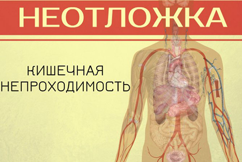 Первая помощь при острой кишечной непроходимости