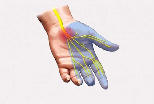 Синдром запястного канала – проблема зависимых от компьютера