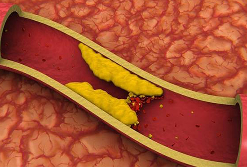 Главные причины появления в сосудах холестериновых бляшек