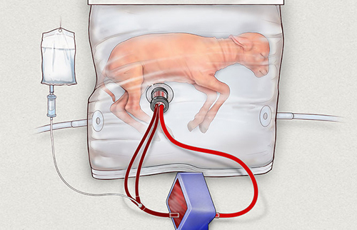 Искусственная матка позволяет выхаживать детей, рожденных сильно раньше срока
