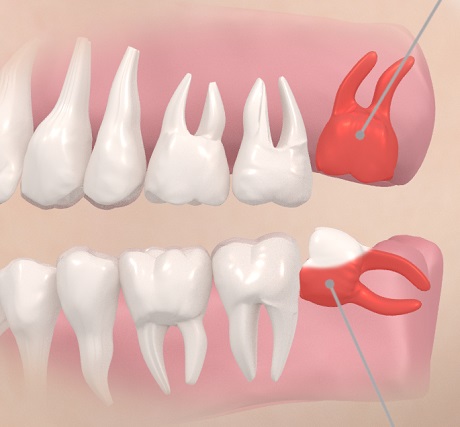 Зубы мудрости: удалить нельзя оставить