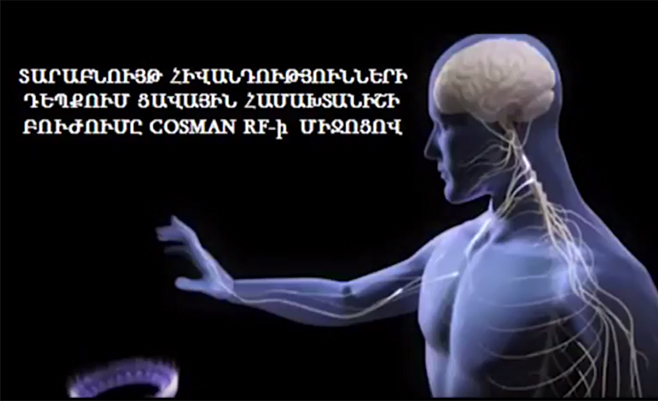 Лечение болей позвоночника: радиочастотная денервация Cosman RF