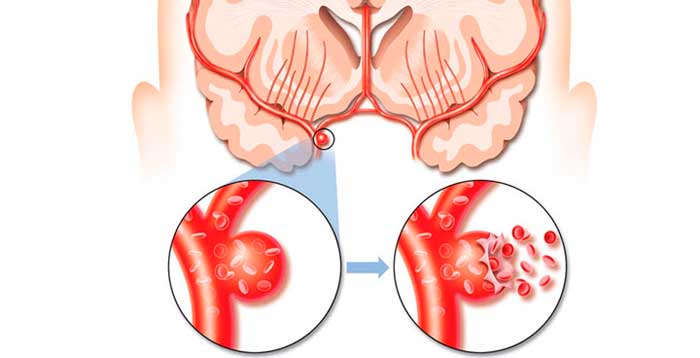 Не только головная боль: симптомы, указывающие на разрыв аневризмы