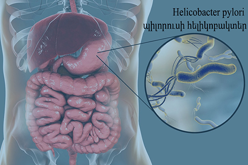 Helicobacter pylori (պիլորուսի հելիկոբակտեր). armeniamedicalcenter.am