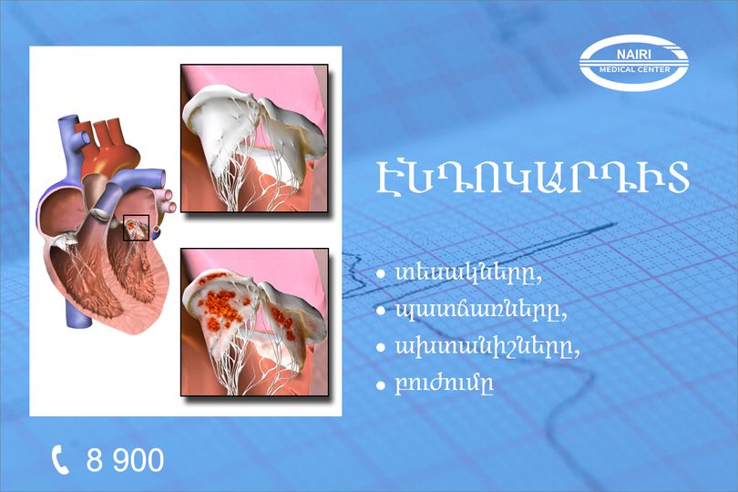 Էնդոկարդիտ. տեսակները, պատճառները, ախտանիշները, բուժումը. nairimed.com