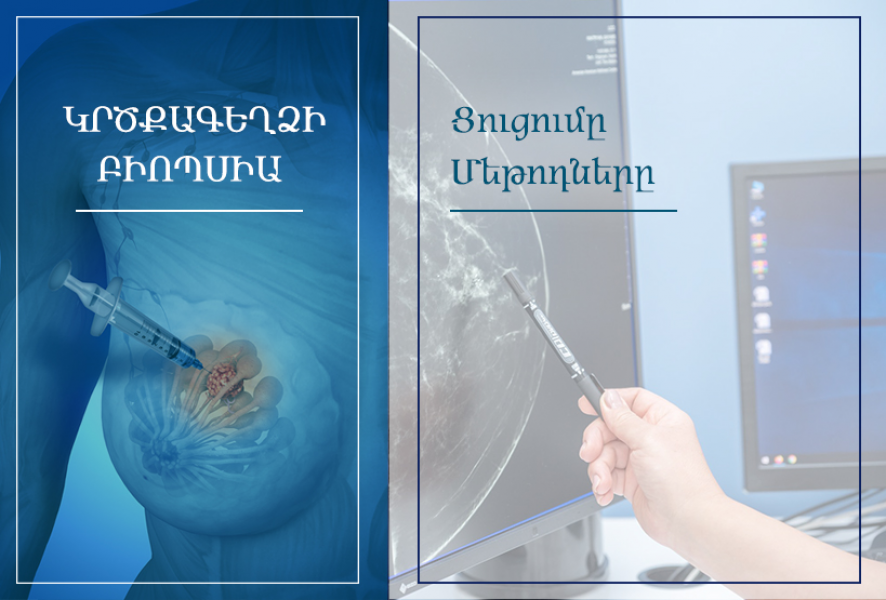 Կրծքագեղձի բիոպսիա. nairimed.com