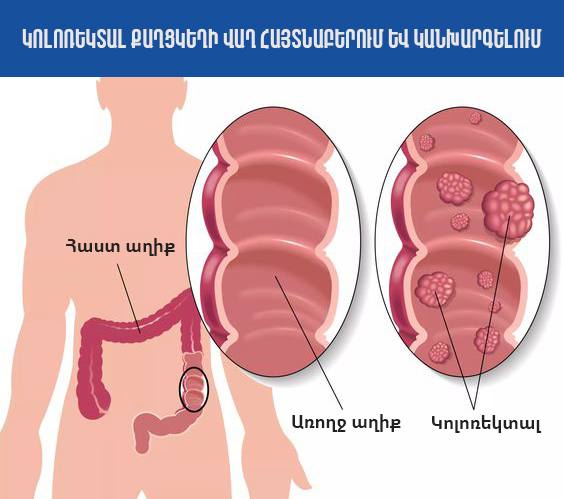 ՀՀ ԱՆ. Կոլոռեկտալ քաղցկեղի վաղ հայտնաբերման սքրինինգային ծրագիր