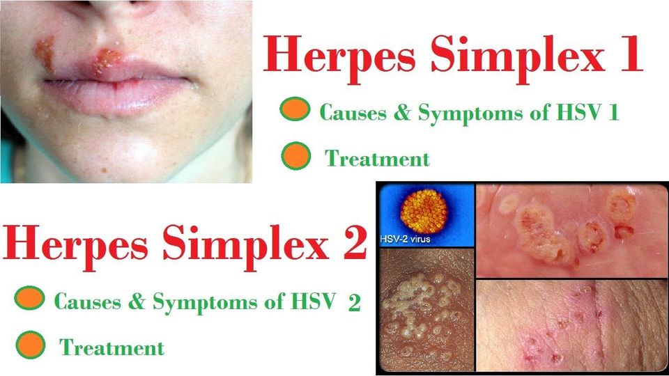 Հերպես (herpes simplex virus 1,2),  igg հակամարմիններ. հետազոտության նկարագրությունը