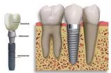 Имплантация одного зуба