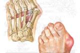 Կոճեր (Hallux valgus).  Կումուրյան պոդիատրիկ կլինիկան առաջարկում է արդյունավետ միջոցներ կոճերի առաջացումը և հետագա դեֆորմացիան կանխարգելելու համար