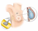 Новые технологии вернут чувствительность груди после операции