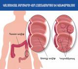 ՀՀ ԱՆ. Կոլոռեկտալ քաղցկեղի վաղ հայտնաբերման սքրինինգային ծրագիր