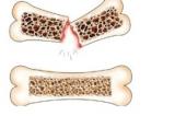 Хрупкая болезнь, или как распознать остеопороз? 