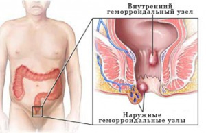 Ինչպես բուժել թութքը