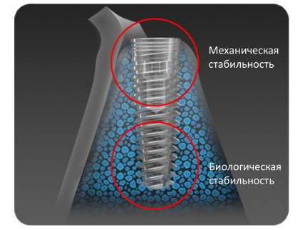 Концепция механизма двойной стабилизации (DSM) в имплантатах С1