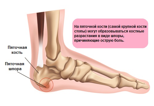 1. Пяточная шпора