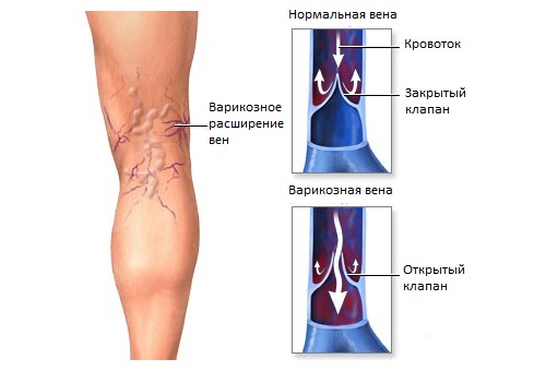 varikoznoe-rasshirenie-ven