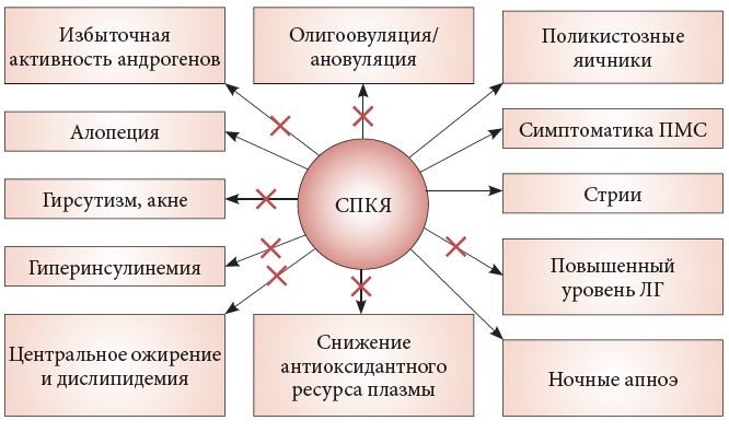 Почему трудно диагностировать синдром поликистозных яичников