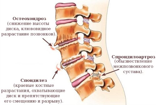 spondiliartroz