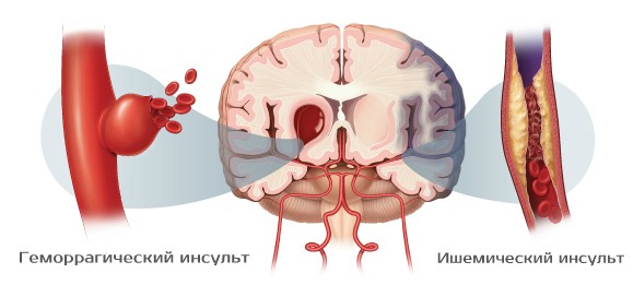 Как распознать первые признаки инсульта и оказать первую помощь