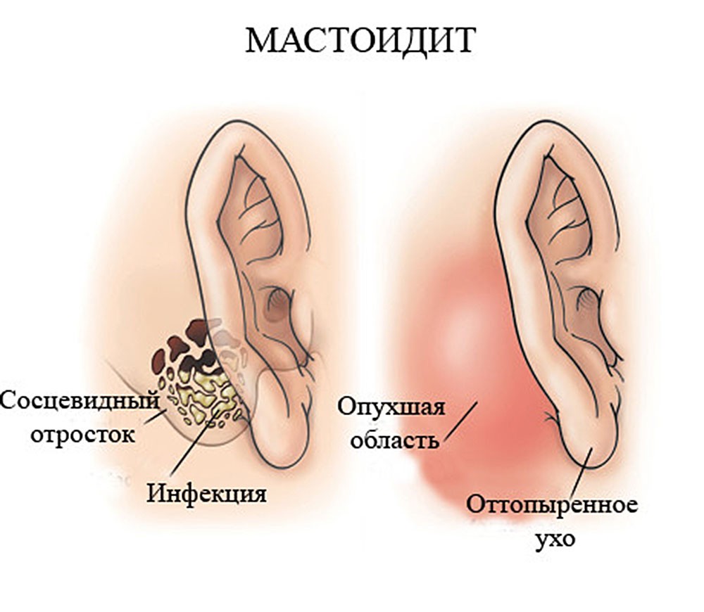 Путь от острого отита до хронического очень короткий