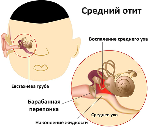 Путь от острого отита до хронического очень короткий