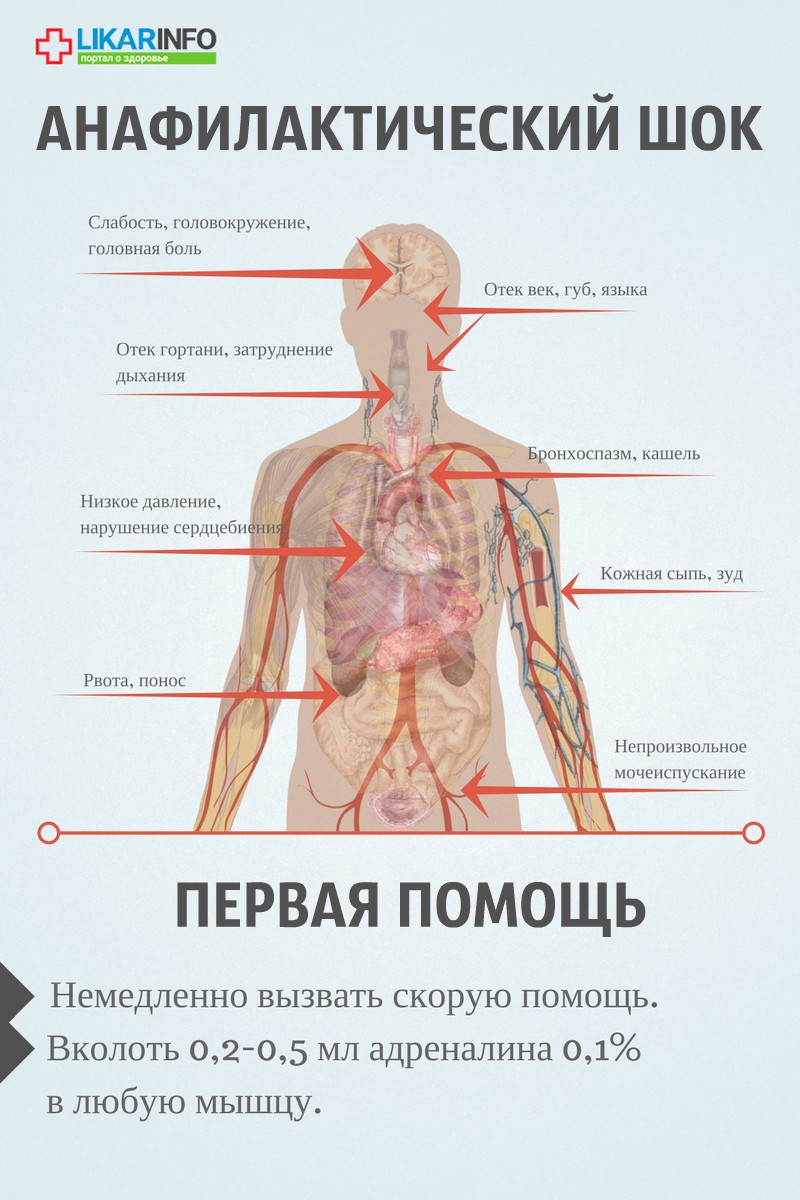 Неотложная помощь при анафилактическом шоке