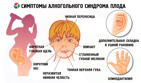  Фетальный алкогольный синдром