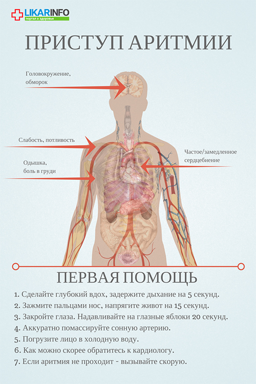 Приступ аритмии: первая помощь