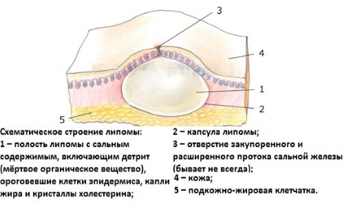 Причины возникновения липом