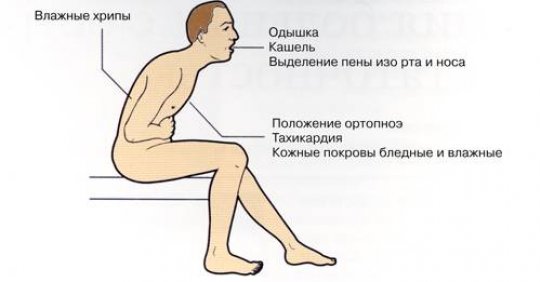 Плеврит: откуда берется жидкость в легких и чем это опасно?