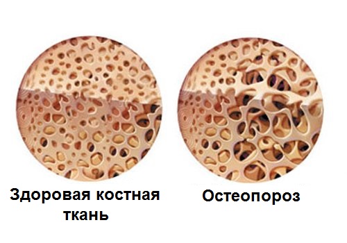 Остеопороз может вызвать боль в костях