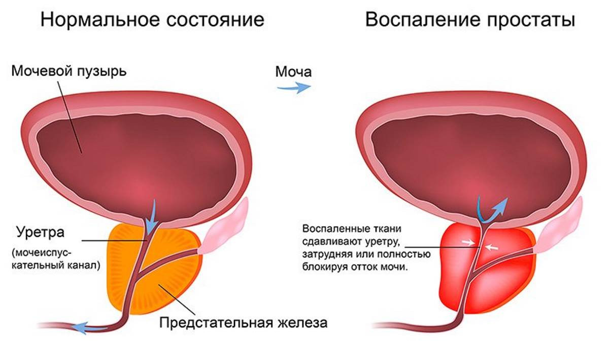 У мужчин тоже бывает цистит