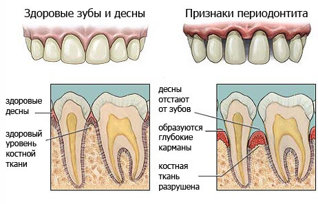  периодонтит