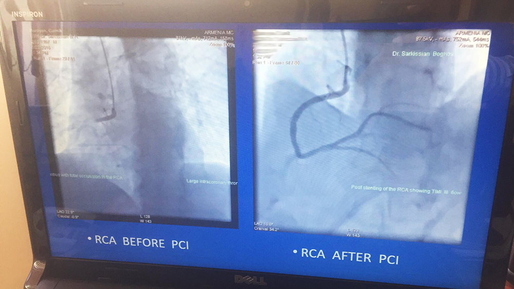 Աջ կորոնար զարկերակի (RCA) ռեվասկուլյարիզացիա և ստենտավորում «Stent for life» ՀՀ պետծրագրի շրջանակում