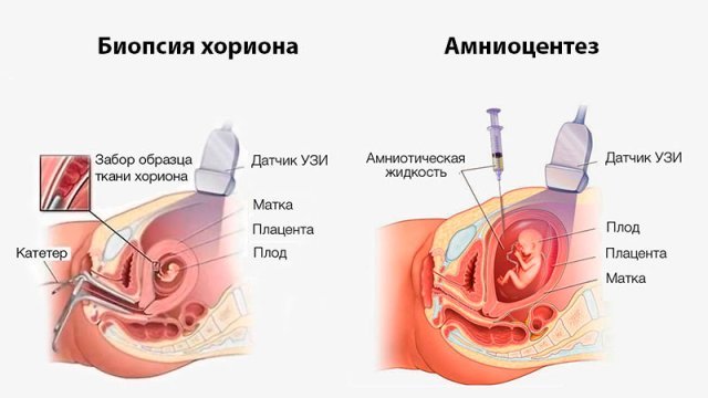  Биопсия ворсин хориона