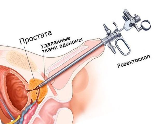 лечение увеличенной простаты