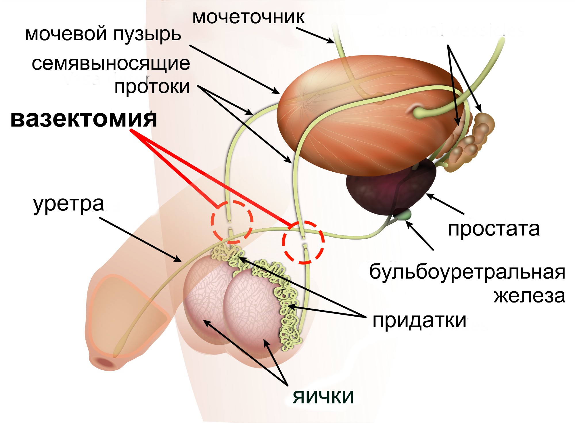 Вазэктомия