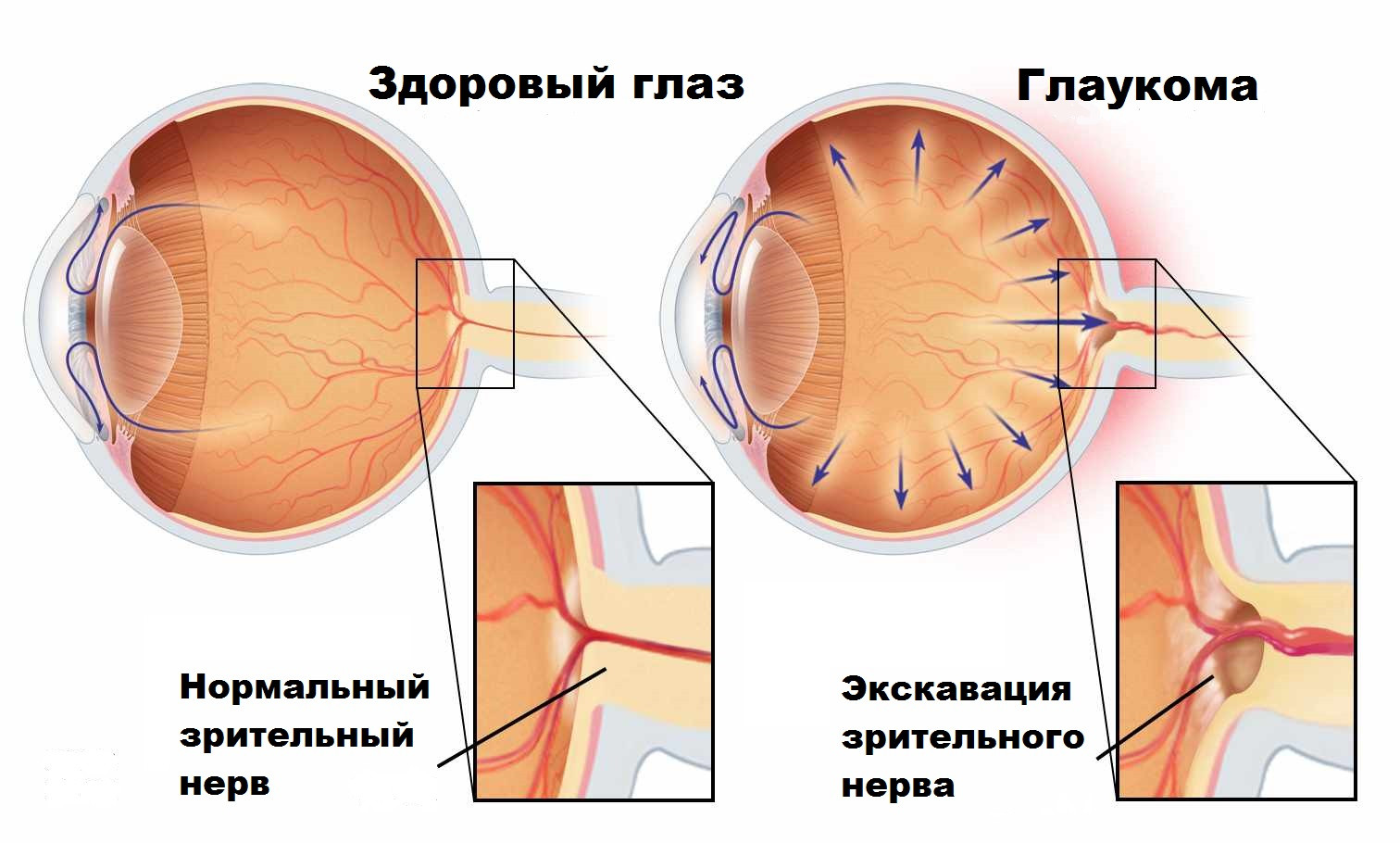 катаракта и глоукома