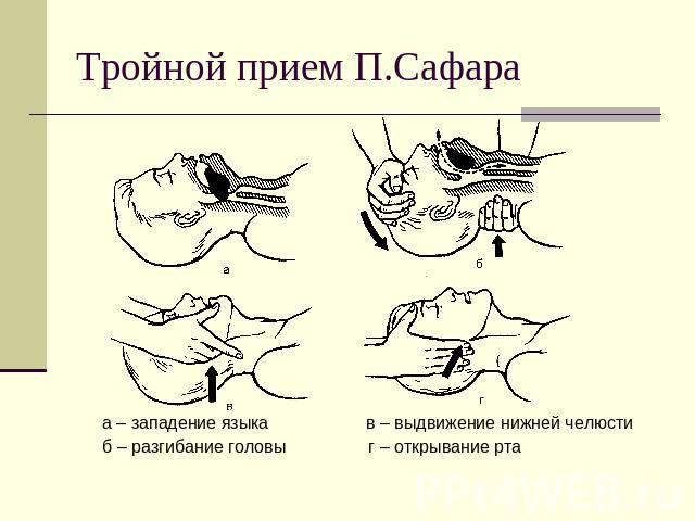 Массаж сердца и искусственное дыхание: как реанимировать человека 