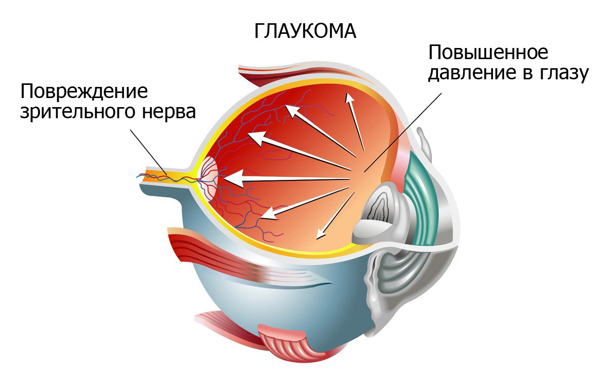 катаракта и глоукома