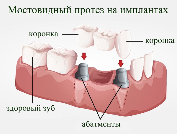 Методика «все на четырех»